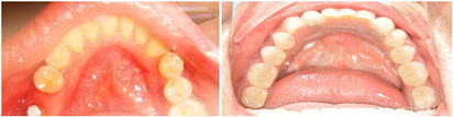种植牙修复虫牙导致的牙缺失案例
